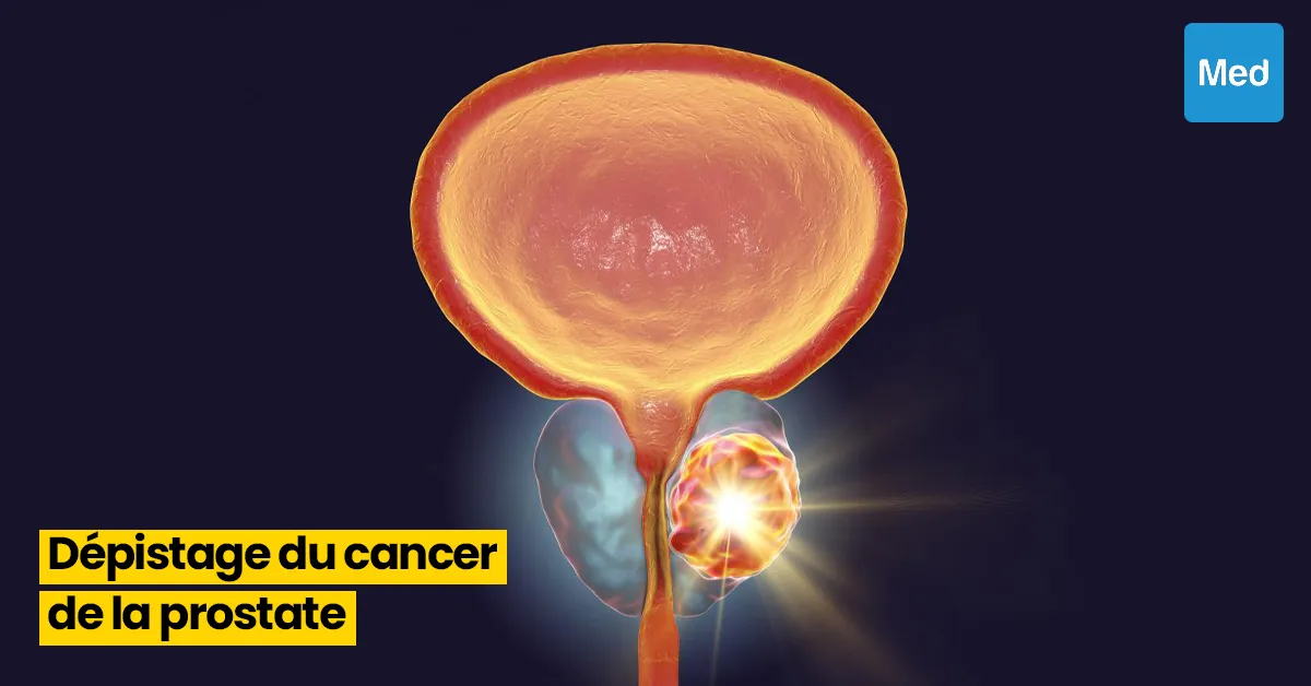 Comprendre le Dépistage du Cancer de la Prostate : Informations Essentielles pour les Hommes